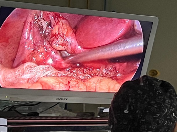 Laparoscopic Cholecystectomy - Copy