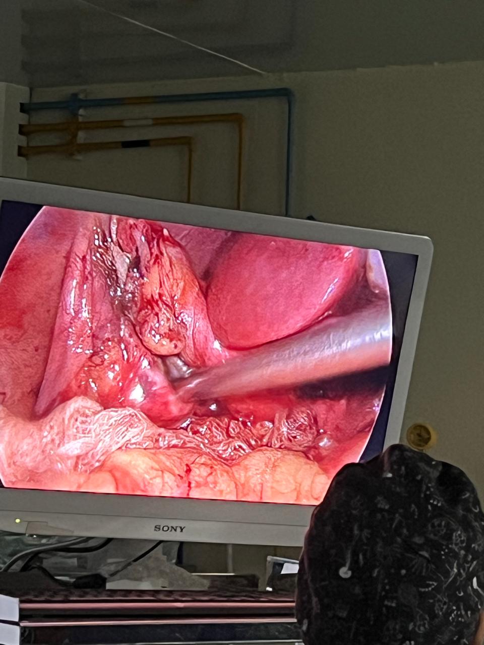 Laparoscopic Cholecystectomy